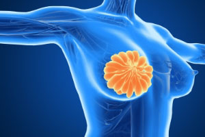 乳腺增生防治：身體發出的信號要注意！